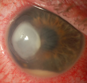 CORNEA SERVICE