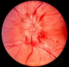 Neuro Ophthalmology